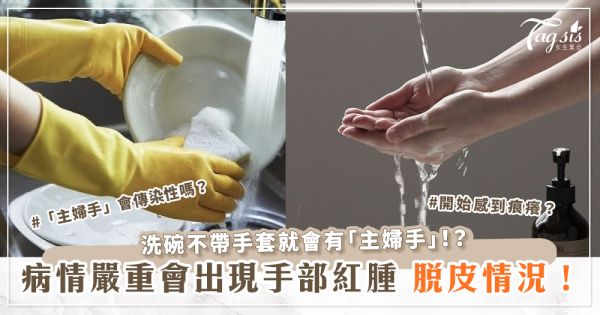 洗碗不帶手套就會有「主婦手」！？「主婦手」會傳染性嗎？病情嚴重會出現手部紅腫、脫皮情況！